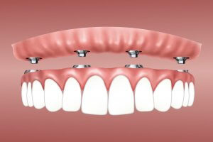 Colocación de implantes dentales