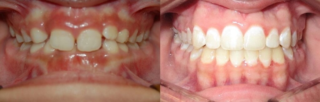 brackets zafiro antes y despues ortodoncia