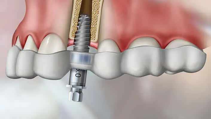 implantes dentales sin cirugía precios 