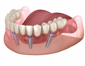tipos de implantes dentales implantes de zirconio