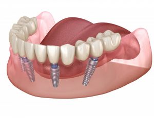 tipos de implantes dentales implantes de zirconio 