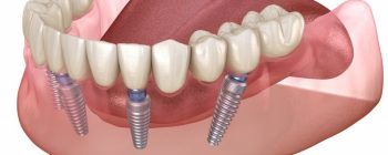 implantes dentales opiniones