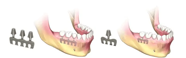 implantes dentales tipos 
