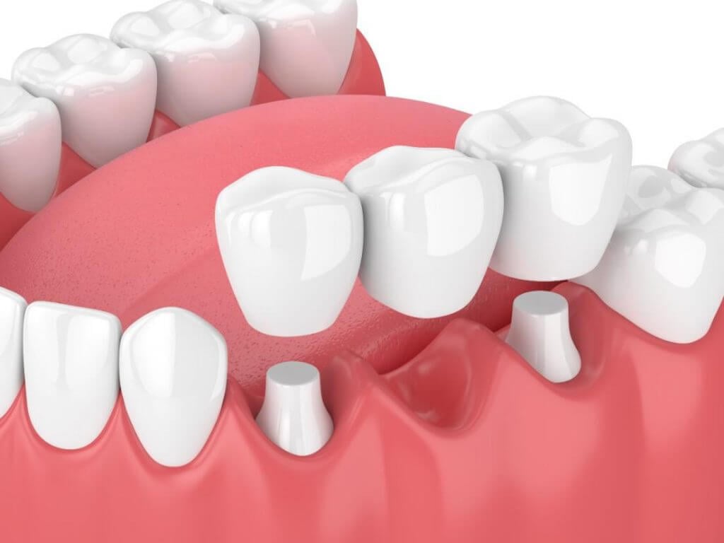 implantes dentales sin cirugía poner dientes sin implantes 