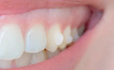 Ataches Invisalign