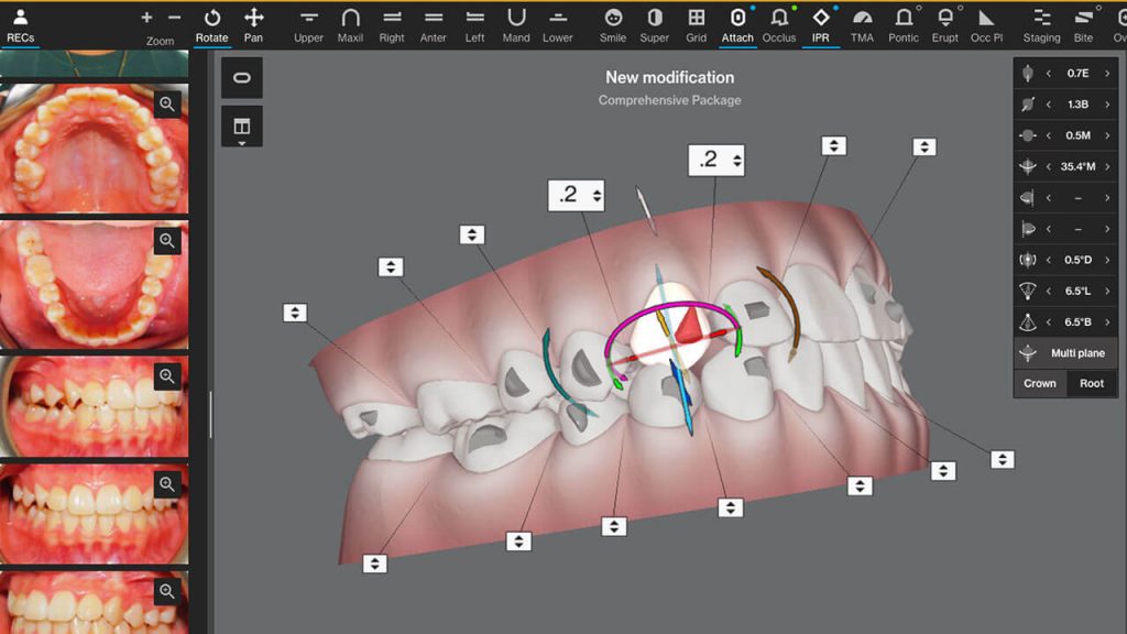 clincheck invisalign