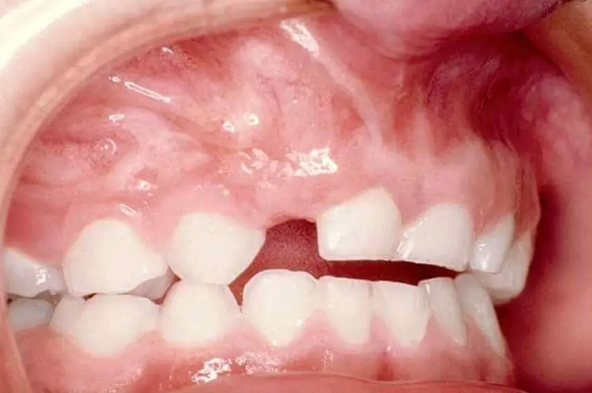 dientes inclinados hacia dentro