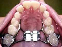 corregir dientes torcidos sin ortodoncia
