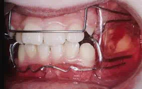 aparato de frankel ortodoncia