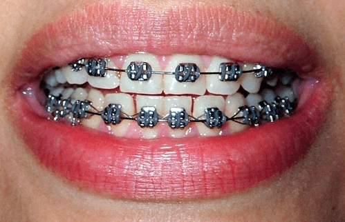 fases de la ortodoncia tiempo después de los brackets