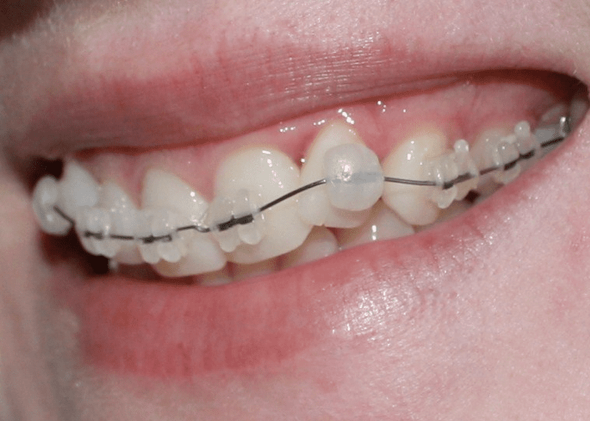 cera dental