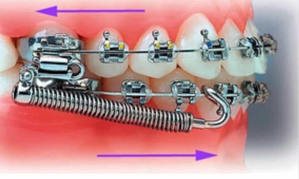 Forsus para qué sirve y qué ventajas tiene en tratamientos ortodóncicos