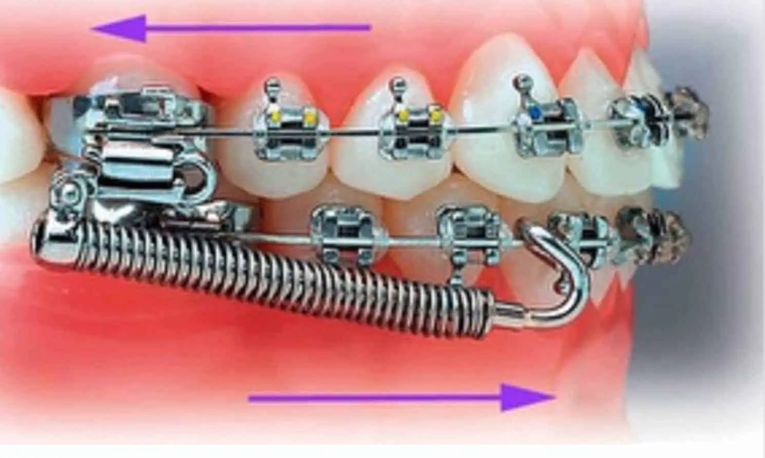 forsus brackets