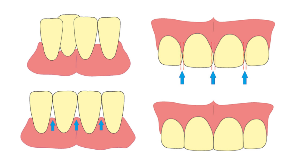 limar dientes paletas