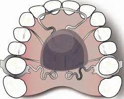 distalizadores ortodoncia 