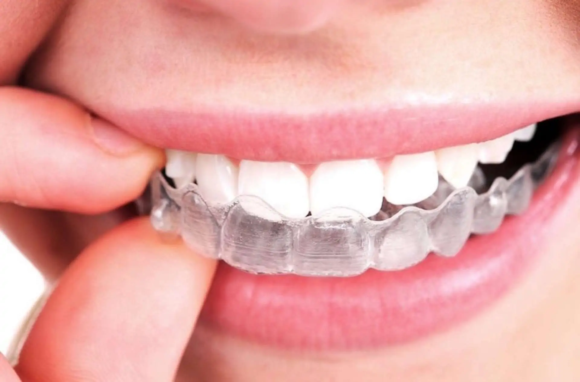 Invisalign duele mucho
