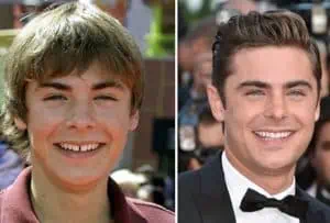 Famosos con Invisalign-Zac Efron