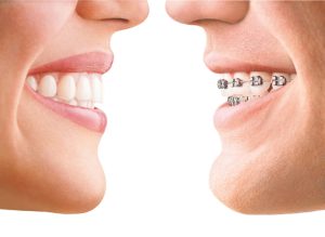 invisalign o brackets