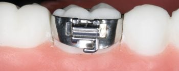 bandas de ortodoncia