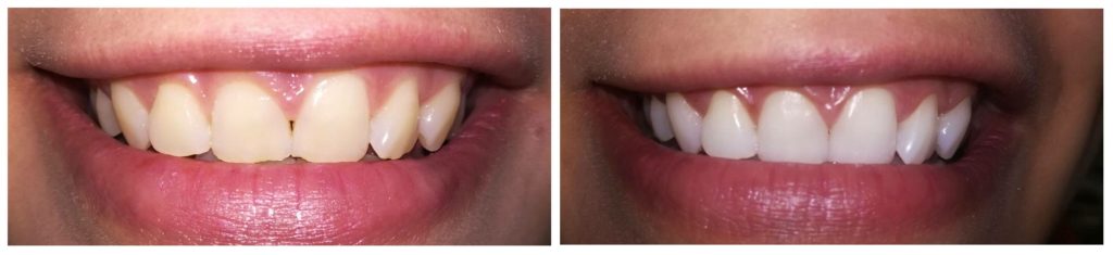 aclaramiento dental antes y despues