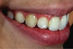 dientes con manchas blancas