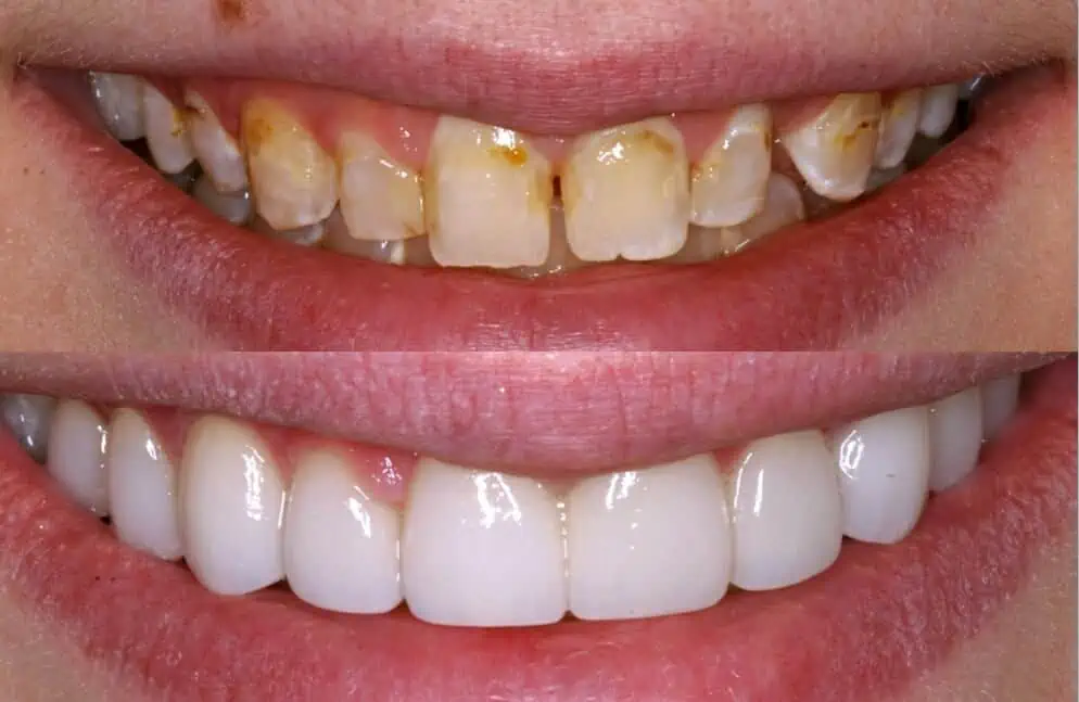 manchas blancas en los dientes niños