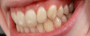 manchas blancas en los dientes