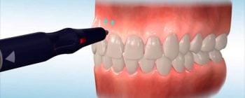 microperforaciones en ortodoncia