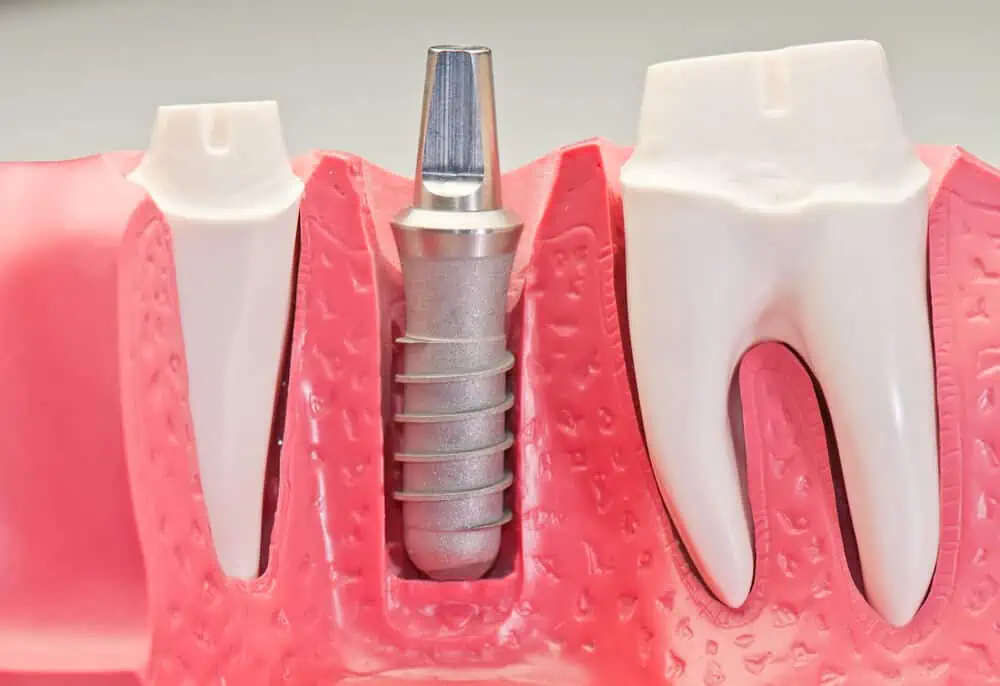 Seguro dental para implantes