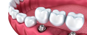 Imagen de puente sobre implantes