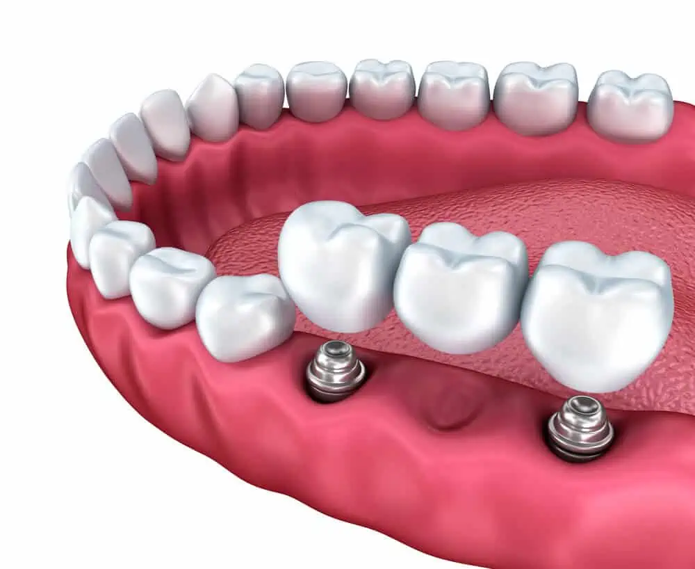 Seguro dental para implantología