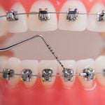 24332Periodontograma: ¿qué es y para qué sirve un estudio periodontal?