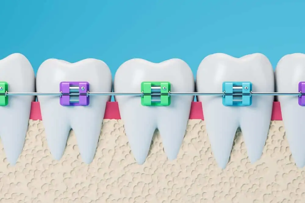 Seguros dentales que cubren ortodoncia