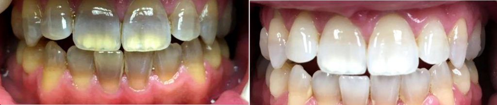 antes y despues blanqueamiento dental