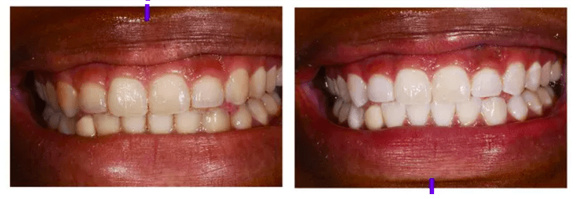 blanqueamiento dental con férulas opiniones