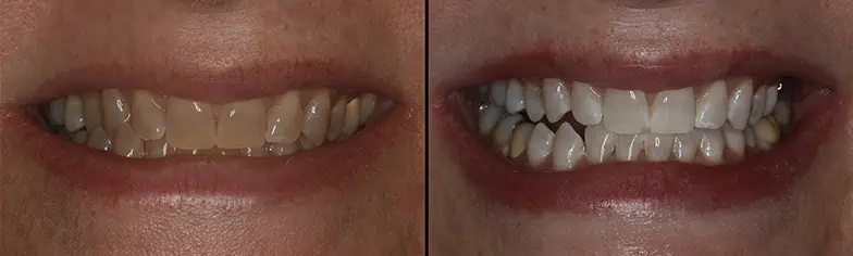 blanqueamiento dental antes y despues real