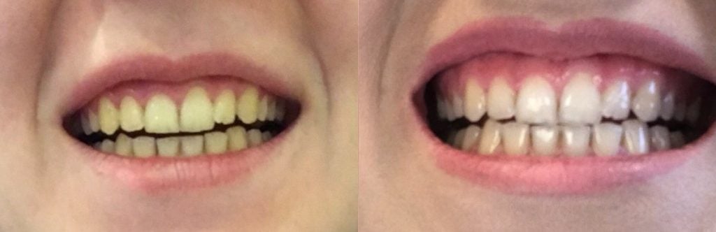 Antes y después del blanqueamiento dental con el kit hismile