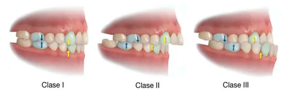 maloclusion clase 2 dental ortodoncia