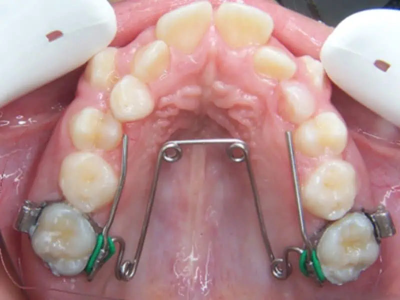 disyuntor dental lento quadhelix