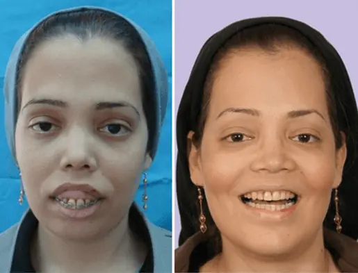 maloclusion clase 2 antes y despues adultos 