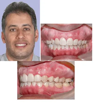 maloclusion clase 2 antes y despues}