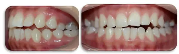 clase 1 dental