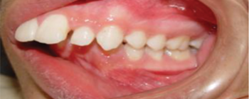 fotografía de una maloclusion de clase II division 1