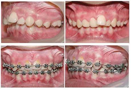 maloclusion 2 antes y despues adultos