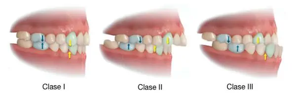 mordida clase 1 dental 
