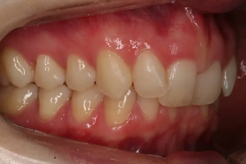 Sobremordida profunda Invisalign