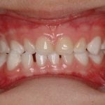 26524Cómo corregir una maloclusión clase 3 con ortodoncia