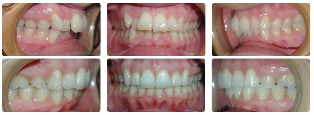 sobremordida invisalign antes y despues