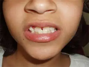 invisalign mordida cruzada