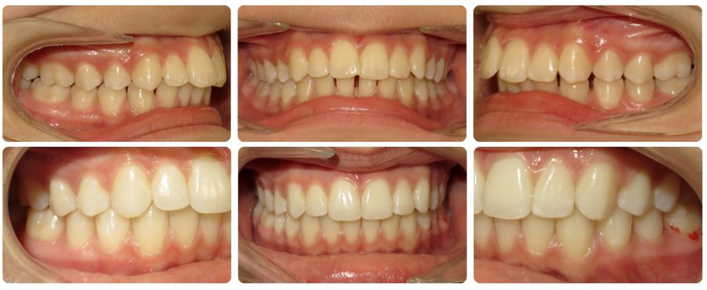 reseñas y casos reales de sobremordida corregida con ortodoncia Invisalign